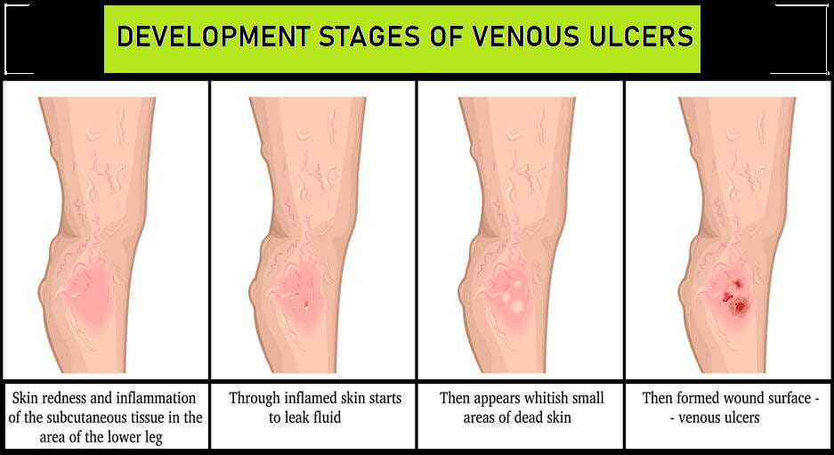 the development of venous ulcers 2024/04/28