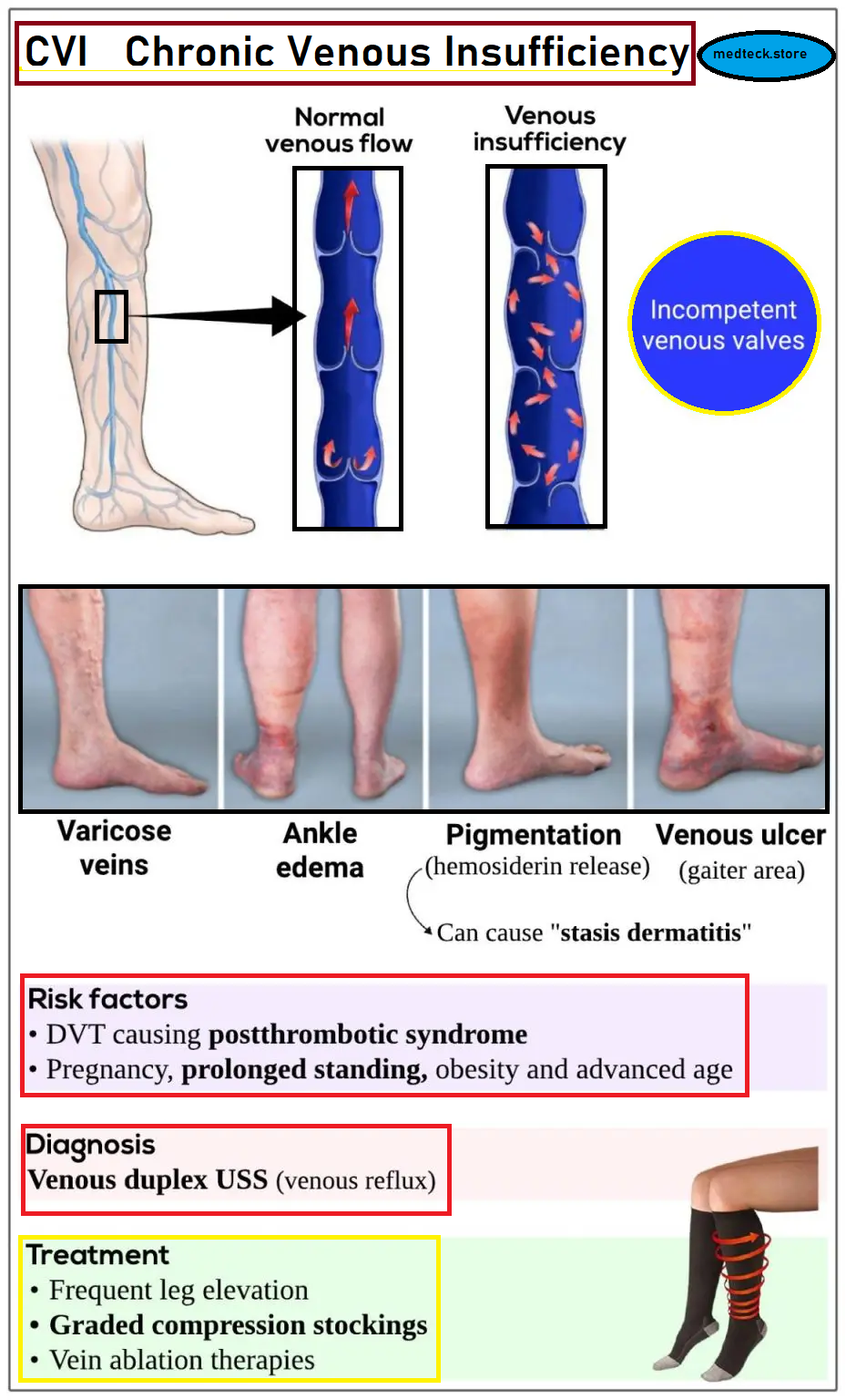 Chronic-venous-insufficiency, medteck.store